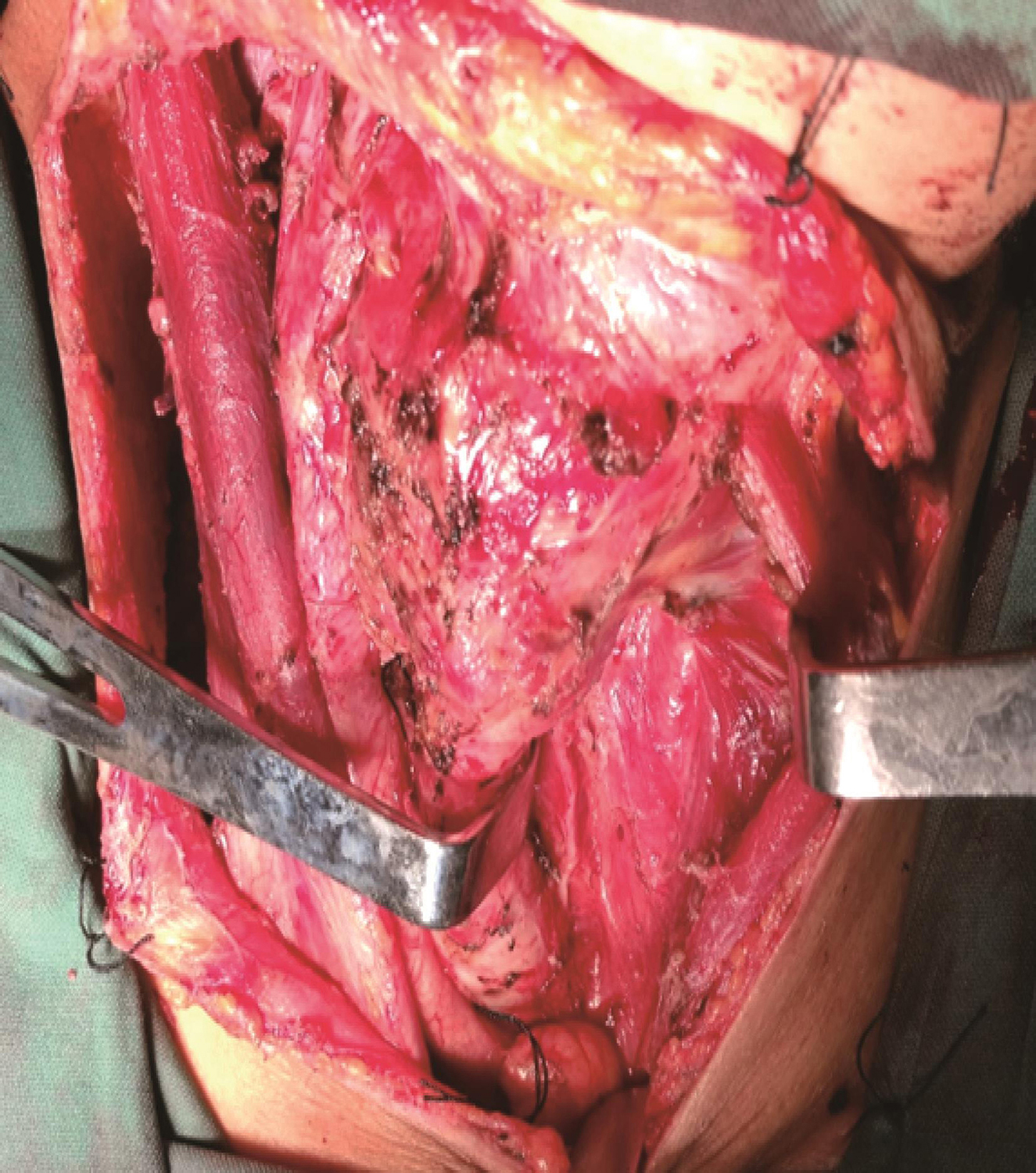 /uploads/image/2025-05-26/162715663图8 甲状腺左叶切除及左侧颈部Ⅵ区清扫后.jpg 图8 甲状腺左叶切除及左侧颈部Ⅵ区清扫后